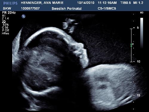 2D ultrasound profile