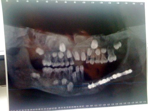 9/15/09-image of Klaus's new jaw,still not fused in the center front lower area-pretty cool? 8 screws/3 plates