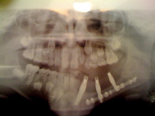 3/31/11--panoramic x-ray showing 3 new implants in Klaus' jaw-placed in front and behind the plates and screws