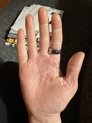 Peeling&#x20;right&#x20;hand&#x20;&#x28;plus&#x20;my&#x20;Oura&#x20;ring&#x20;and&#x20;pile&#x20;of&#x20;mail&#x20;the&#x20;night&#x20;I&#x20;came&#x20;home&#x20;in&#x20;January&#x29;