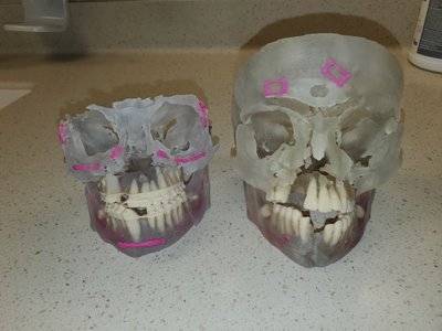 Left: Model for planning the 2022 surgery. The braces have kept things lined up nicely. Right: Model for planning the 2019 surgery. Notice how the top teeth are shoved up under the cheek bones & the back teeth do not align.  The pink areas are titanium pieces holding things in place. 