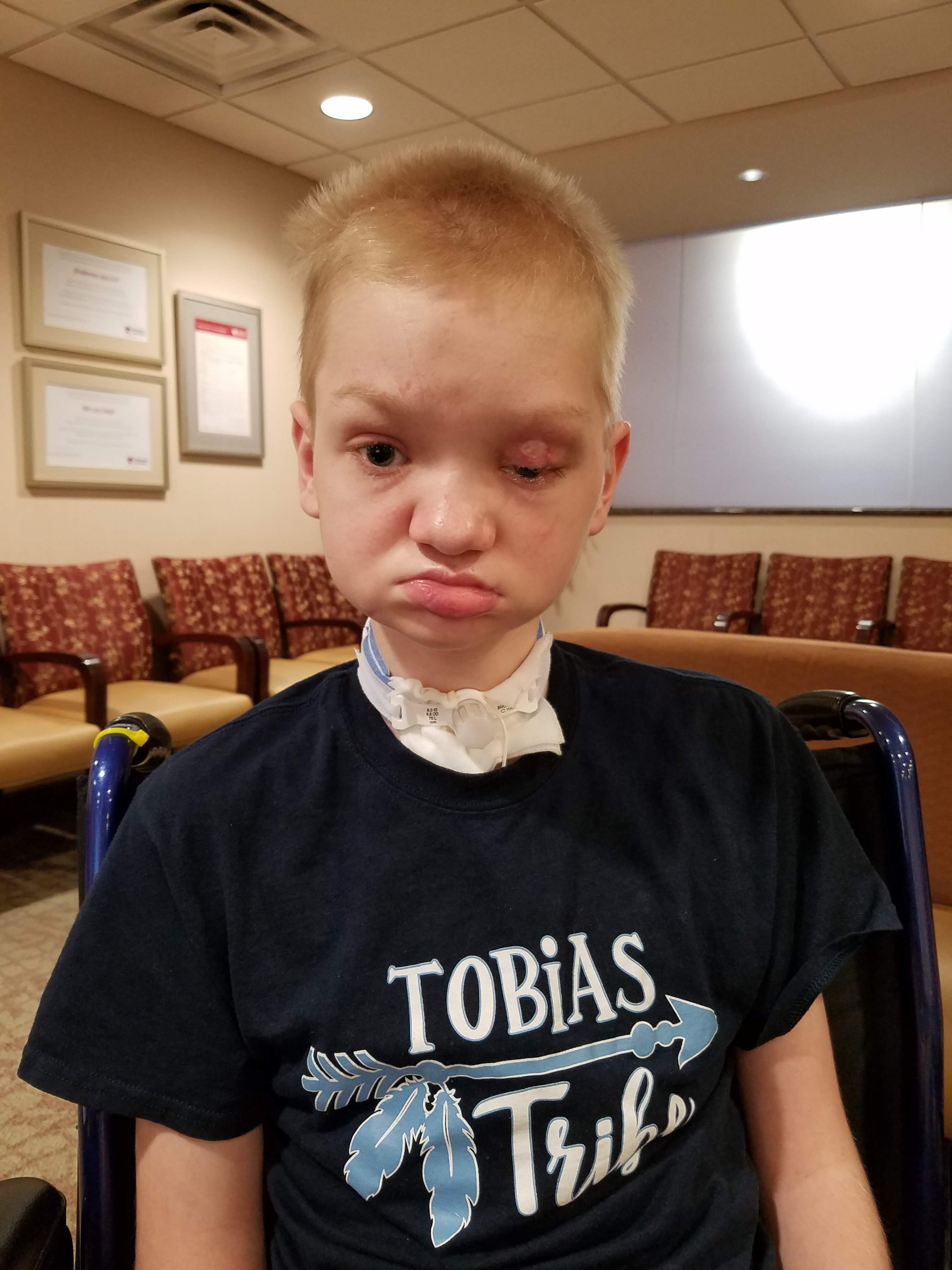 Caleb's face before reconstruction surgery #1 in July, 2019.