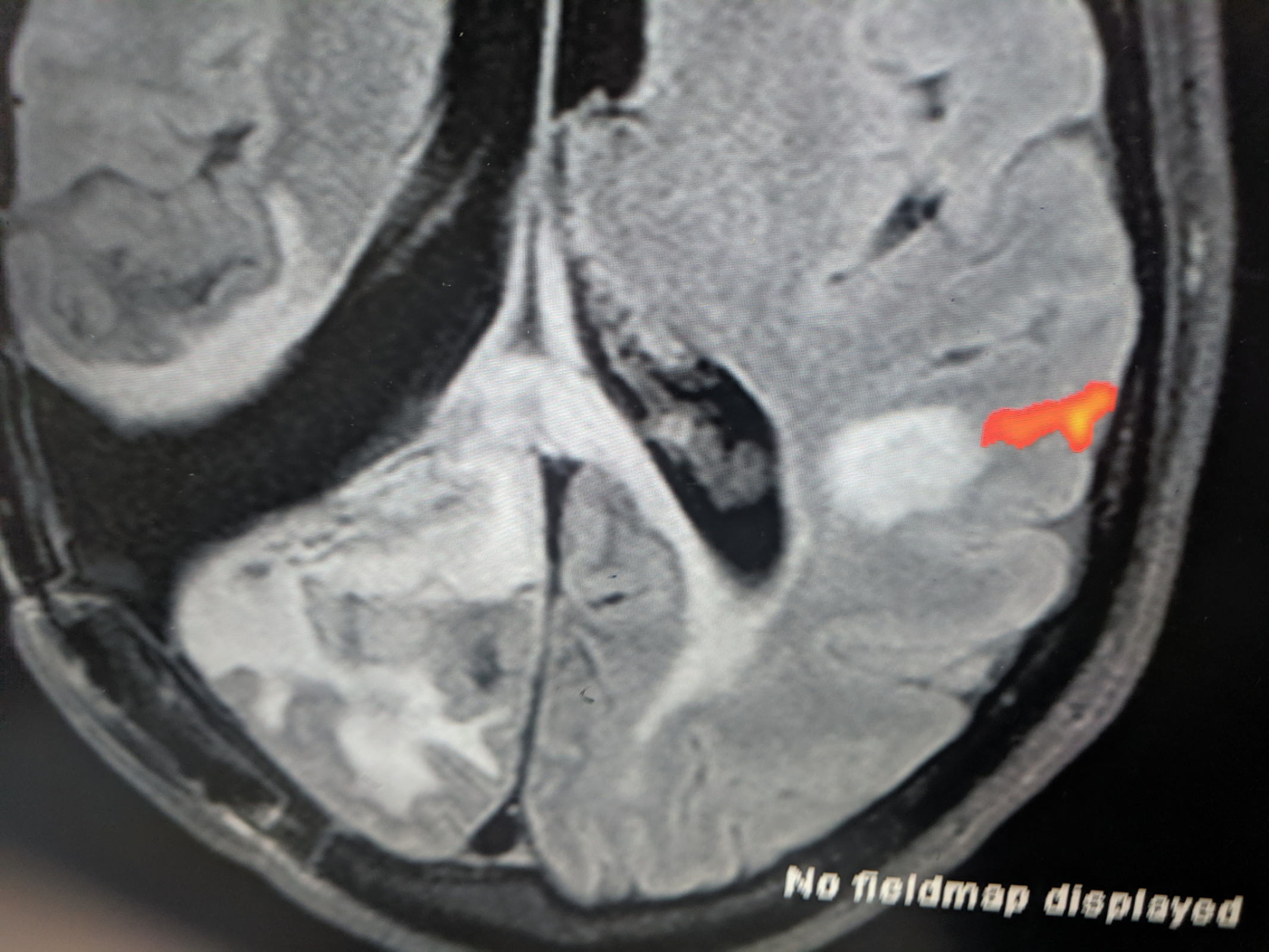 From my last MRI: area used for language in red, tumor touching it on the left, in light gray