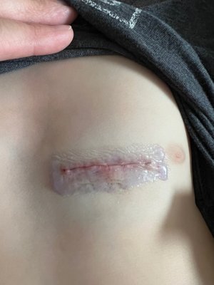 Incision&#x20;looking&#x20;good