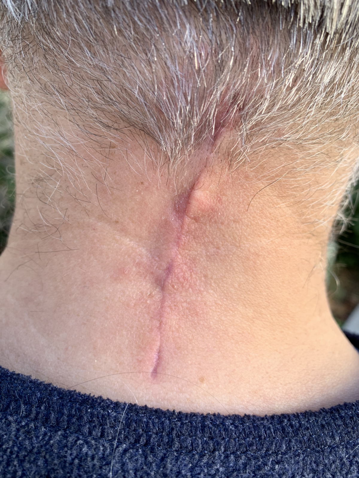 The incision is healing beautifully. The trapezius beneath it will take a little longer. 