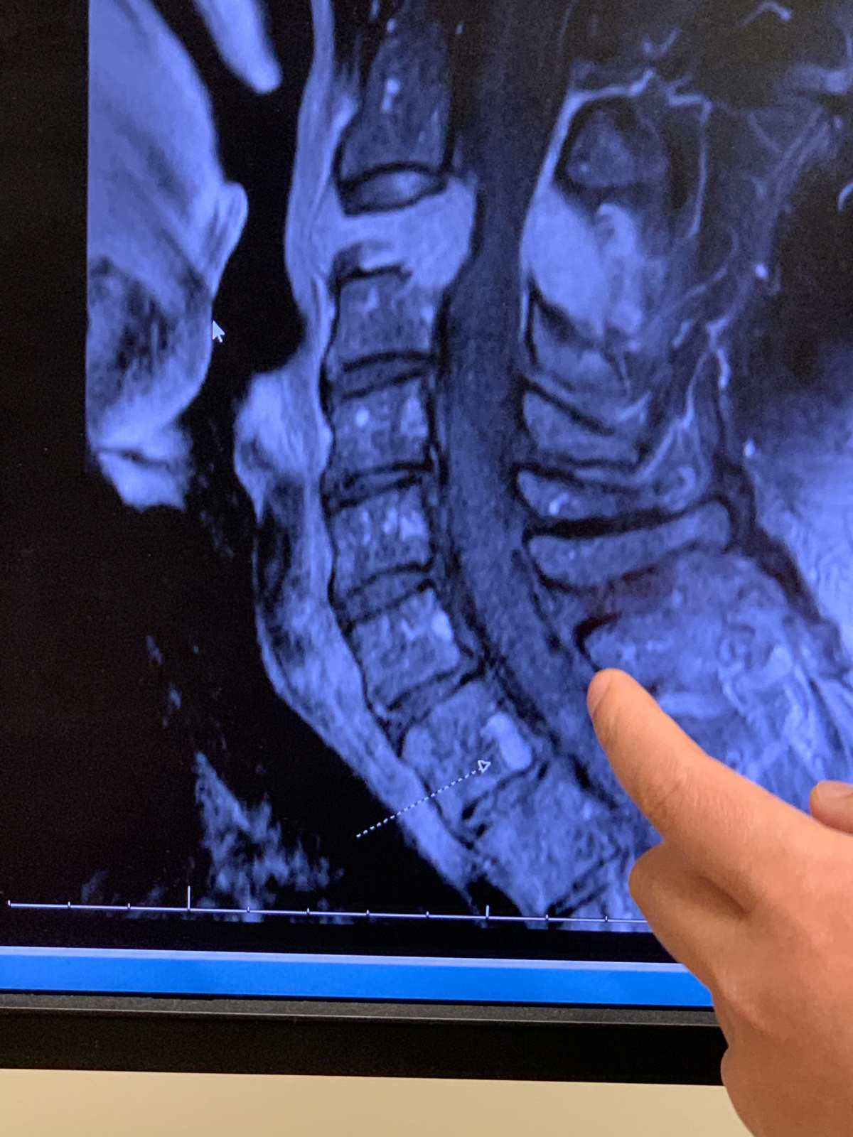 His hematology oncologist showing us the pre-surgery imaging.  You can see the tumor at the top, squeezing the spinal cord. The surgery relieved all that pressure, and the radiation will zap the tiny bits remaining that the surgeon couldn’t safely remove. 