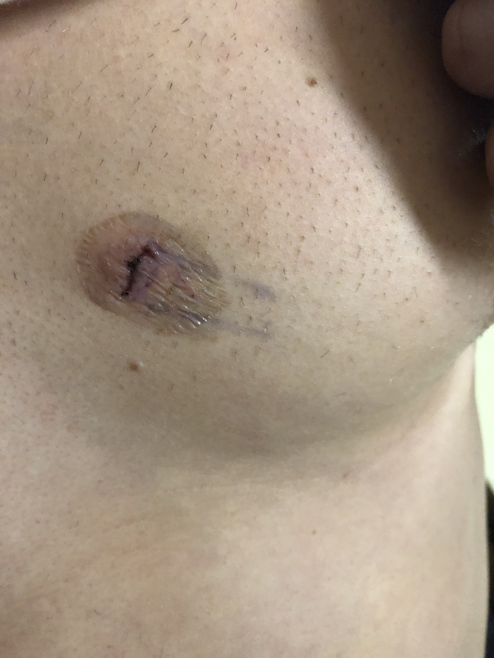 Incision site for the Linq monitor...one day later with a little bruising.