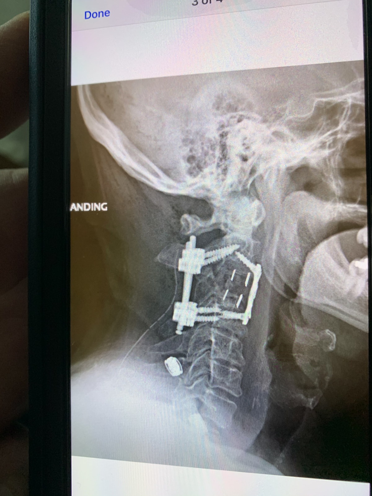 In the back, screws are attached to C2 and C4 vertebrae. In front is a plate that secures the replacement vertebra or cage. The four straight lines are markings that identify the plastic cage on diagnostic imaging. 