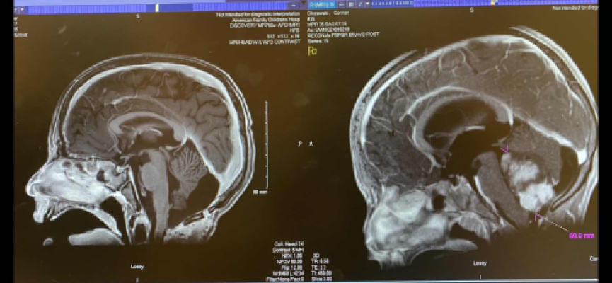 Left image is his current scan compared to the right pre-surgery scan. You can see the ventricles are so much smaller and the white tumor is gone!