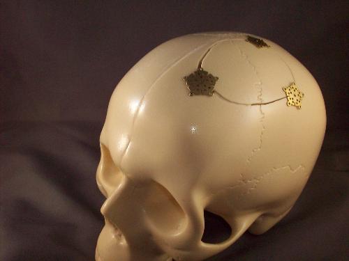Post craniotomy, or skull with titanium (slight location difference).