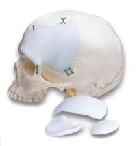 Post cranioplasty or skull with plastic (stunt skull).