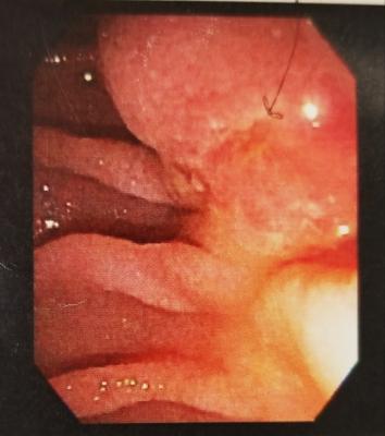 The offending lesion that caused the original duct blockage.  Photo from the Endoscopic Retrograde Cholangio-Pancreatography (ERCP).