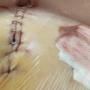 My incision