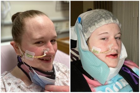 Right before and right after my oral surgery.