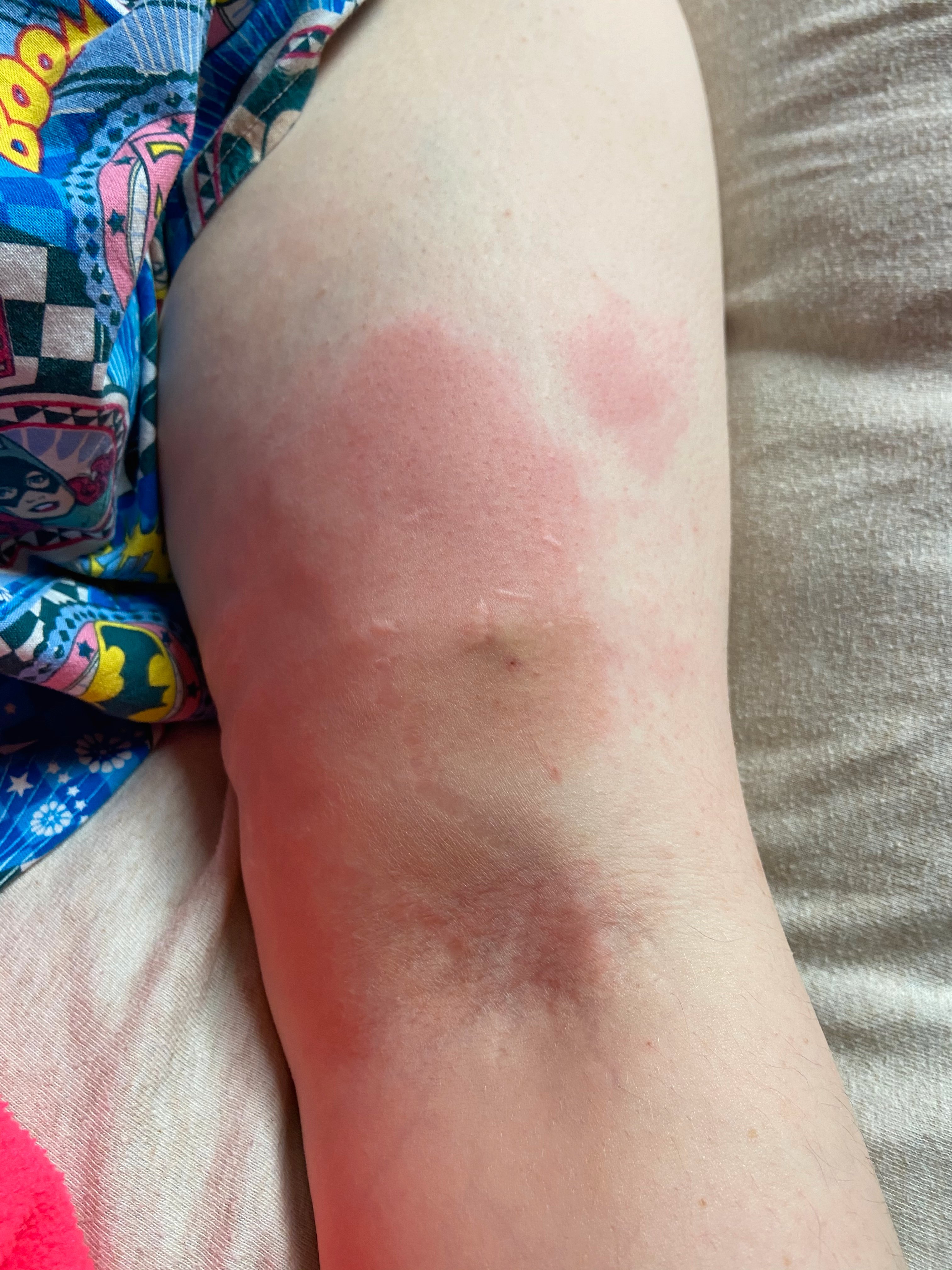 Can you tell where the DVT is?  Since this picture, my arm has become a little more swollen, but isn't quite as red.
