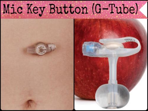 A glimpse of a Mic Key Button G-Tube {left: G-Tube in place & right: what the whole thing looks like}