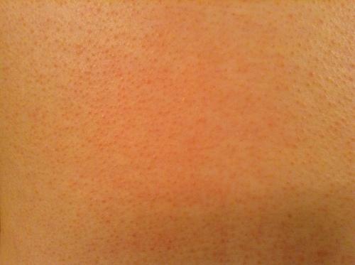 The rash I was completely covered with thanks to quinoa and MCAS :P