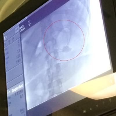 This is the X-ray they took to check the placement of my feeding tube. The tip of the GJ tube is supposed to be in my intestines; however, as you see in this X-ray, it is coiled in a tight circle. This is the most coiled it has ever been!