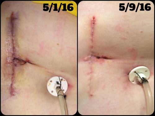 This is comparison pictures showing my surgery site when I got home & yesterday after I got the stitch taken out of my old stoma. On the left you will see the 3 1/2" incision, old stoma right beside it, and my tube right beside that.