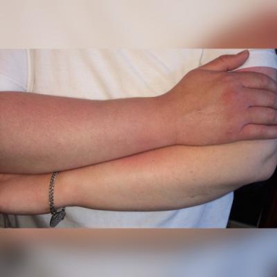 Here are my arms when having the circulation issues with my right arm. You can see how the right arm is noticeably darker.