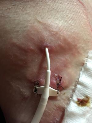 PICC line site (possible infection)