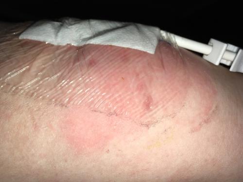Swelling and redness coming out  from under the PICC dressing.