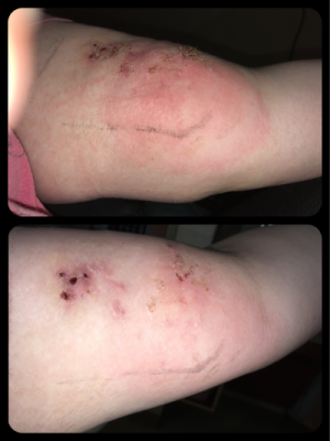 Top picture was from last night and the bottom picture is from this morning.  Notice how the saggy swelling is gone and how much the redness has lightened!?  Sorry the pictures are at a little different angles, but I think you can still see the change! :)