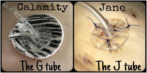 Meet Calamity the G tube and Jane the J tube :)