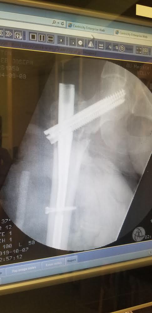 Caleb’s right hip. Permanent rods & screws!