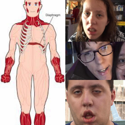 These are the faces of my three oldest adult children now. They are beautifully created and loved. But these are also faces of Myotonic Dystrophy. The muscles in their eyes, mouth and jaw line show how they are working with these challenges. I’m sharing it because, like Sarcoidosis, there is no cure and it has been hard to find treatments. It affects more than muscles but as we learn more, I recognize how it evades mental functioning to varying degrees and with variable scope. It has hurt my heart to see the trials and obstacles that have overcome. They are my heroes, warriors and we are all overcomers in this family.  I have no doubt God is using them for a purpose and plan in life.  Jeremiah 29:11 Claim that Hope and a future.
