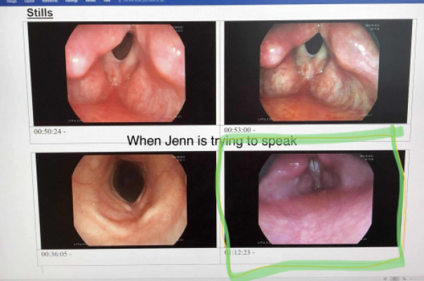 Jenn’s vocal cord area