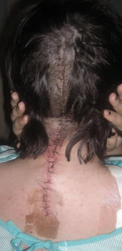 Swedish Neurosurgery scar - March 11,2009. Ouch.