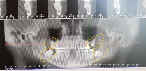 Four bottom teeth are gone! 
Impacted Wisdom Teeth will need to go. Top ones are fused to the bone. Bottom ones are sideways and deep in the jaw. All four need to be removed by Oral surgeon.
Date:TBD