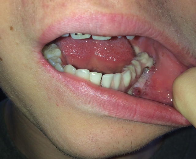 April 2019 - new lower left prosthetic bridge complete.  This is his 5th set of teeth.  Made in Boulder by Dr. Gordon Gates